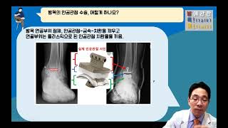 {발톡!} 70대 환자의 발목 인공관절 수술 사례