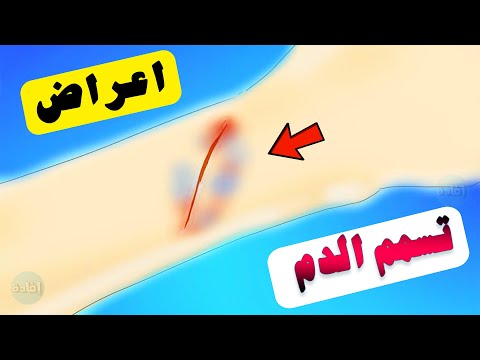 فيديو: تسمم الدم و تجرثم الدم في الكلاب