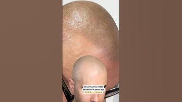 Best Examples of Natural SMP                 #scalpmicropigmentation