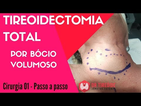 Tireoidectomia total - Cirurgia #01# Passo a passo | Dr Jônatas Catunda