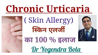 Chronic Urticaria Skin Allergy क क रण And Complete Treatment In Hindi