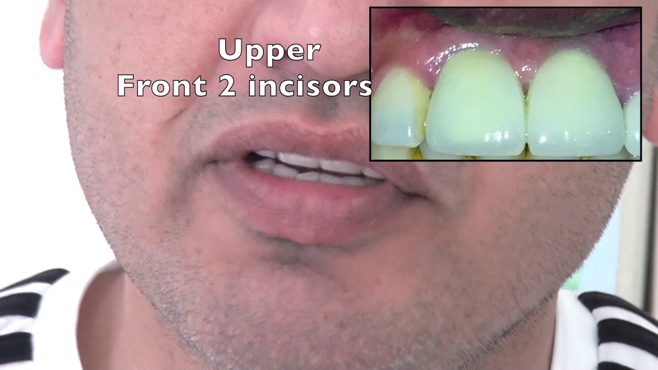 teeth dental implants gap extraction procedure smile india dentist