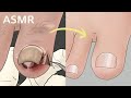 Satisfying ASMR Ingrown toenail removal treatment animation