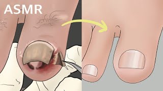 Satisfying Ingrown toenail removal treatment animation screenshot 4