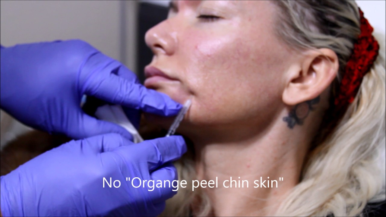 Botox injections in Chin, Improves Orange Peel Chin Skin YouTube