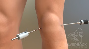 Knee Arthroscopy Animated Video