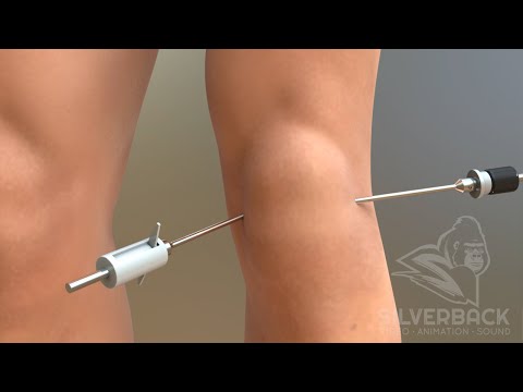 Knee Arthroscopy Animated Video
