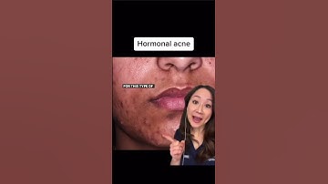 Treat Acne Like a Dermatologist #shorts