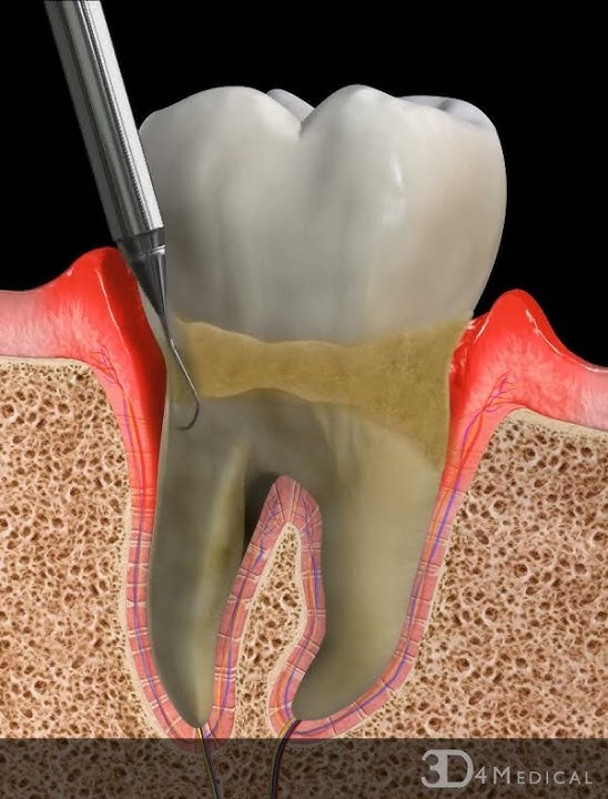 Periodontal Cleaning