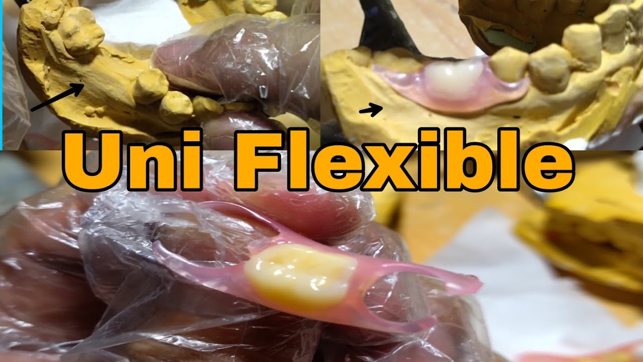 Pustiso Unilateral Flexible Denture. YouTube