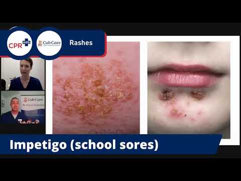 Video: What To Do If A Child Develops A Small Rash On The Back