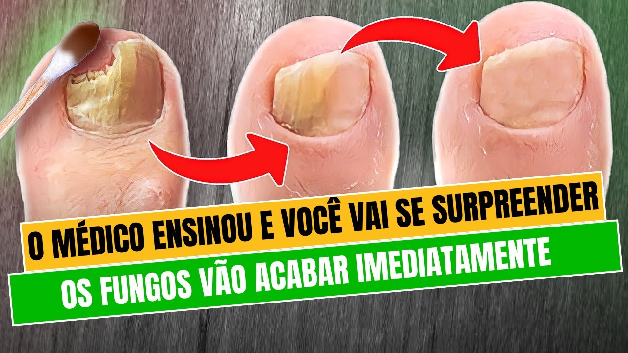 Como me livrei de fungos nas unhas para sempre! Tratamento caseiro para ...