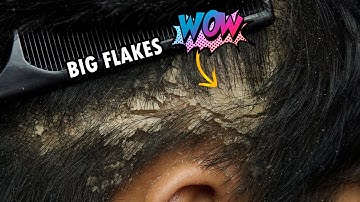 Itchy Dry Scalp Removal On Right Side!!! Dandruff Scratching Satisfying #345