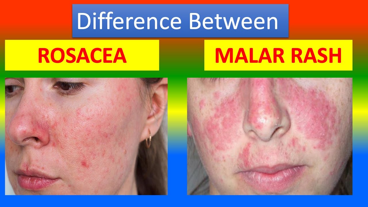 Difference Between Rosacea And Malar Rash Youtube