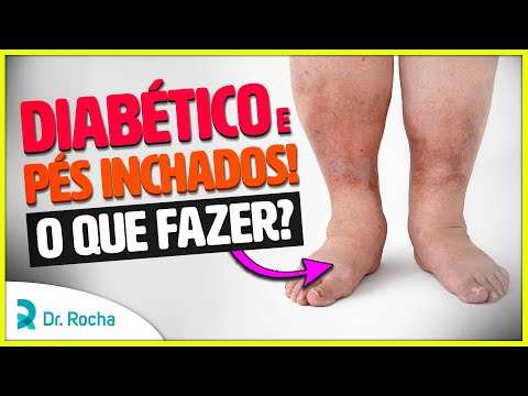 Diabético com PÉS INCHADOS! O que fazer? 🦶🏼🚫