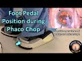 Foot Pedal Position during Phaco Chop Cataract Surgery