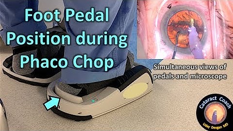 Foot Pedal Position during Phaco Chop Cataract Surgery