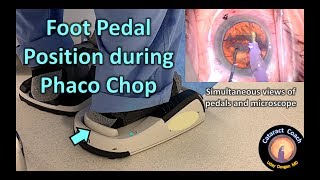 Foot Pedal Position during Phaco Chop Cataract Surgery