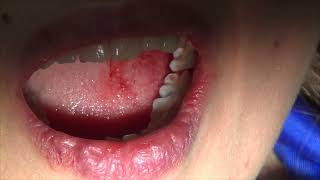 Dental Surgery Small Cyst Removal by Oral Surgeon Dr Clove #Dendal