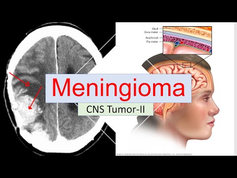 Video: Hjerne Meningioma: Behandling, Kirurgi, Prognose, årsager