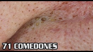 Super Extreme Pimple Popping Compilation!  Zits and Acne!  Dermatology Video
