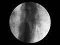Coronary angiogram - muscle bridge