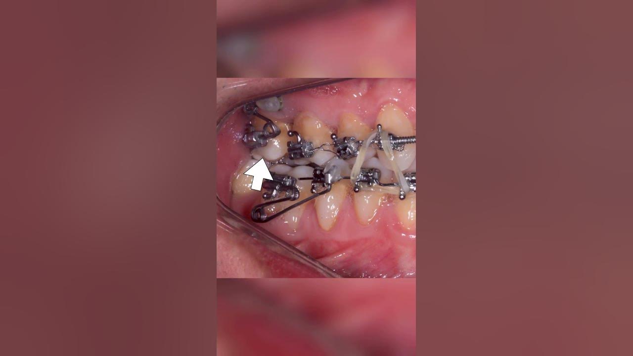 FINISHING STRATEGIES IN ORTHODONTICS ORTHODONTIC TIPS Shorts YouTube