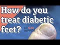 How to Care for Diabetic Feet?  FEET-ure Friday (2021)