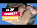 Old Problem In A Young Patient: TREATING AND TRIMMING TOENAIL FUNGUS