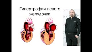 Гипертрофия левого желудочка – проявление и лечение.