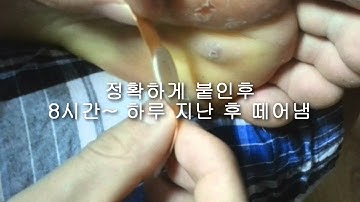 티눈 밴드 사용법 및 티눈 제거영상