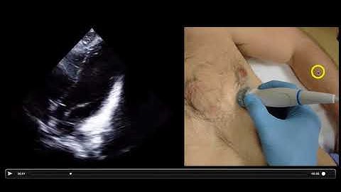 Optimizing Cardiac Views with Ultrasound
