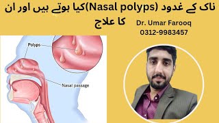 Nasal polyps and its Homeopathic treatment