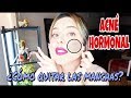 Cómo quitar las manchas del ACNÉ | FOTOS del ANTÉS y DESPUÉS *cara, espalda y pecho*