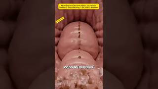 What Doctors Discover When Your Colon Suddenly Stops Moving — $1,200 to $18,400