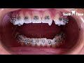 Braces Regular Check ups - Two Coil Springs - 3 months in braces - Tooth Time New Braunfels