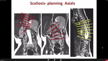 MRI PROTOCOL SPINE PLANNING & TECHNIQUES
