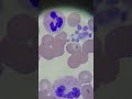 Hematology patient with low platelets part 1