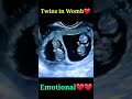 Development Of The Baby In The Womb Month By Month! Twin Embryo Doing Growth in Moms Belly 👩