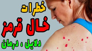 علت ایجاد خال قرمز روی پوست 😧 راه های درمان خال قرمز سطحی و خطرات بروز خال پوستی ❌