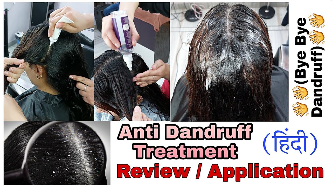 Dandruff Treatment |  Dandruff का parmanent solution | dandruff को जड़ से खत्म करे | sumansi Sahgal