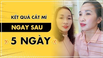 Chia Sẻ : Cảm Nhận Của Chị Khách Sau Khi Cắt Mí 5 Ngày | Bác Sỹ Tuấn Dương