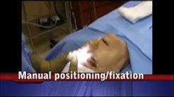Browplasty (brow lift) with radiofrequency neuroablation and bioadhesive fixation