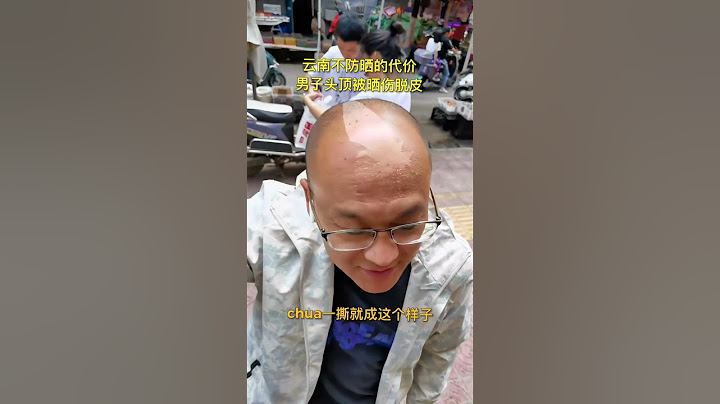 男子头顶被晒伤脱皮…这就是不防晒的代价？#shorts