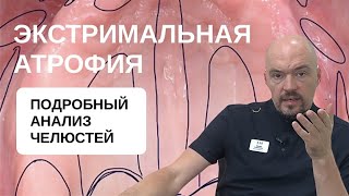 1.2 Подробный анализ беззубых челюстей.