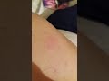 Ухапване от комар в апартамента ни