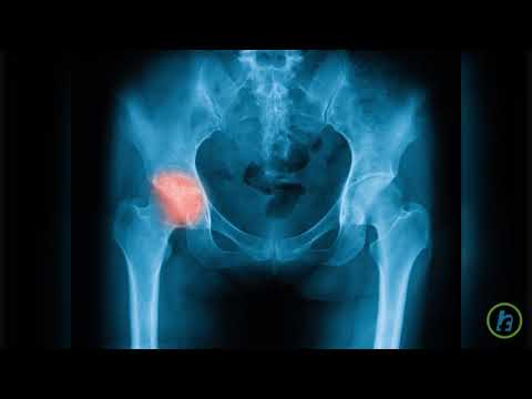 Tratamentul artritei articulare la nivelul șoldului