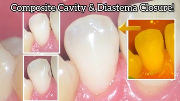 Anterior Tooth Cavity & Diastema Closure with Composite Step by Step