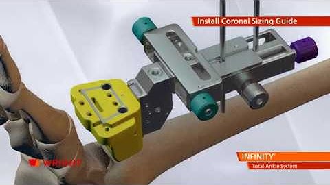 MoveWright Infinity: Total Ankle Replacement