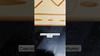 z technique for appendicular stump✨#Appendectomy#Surgery#GeneralSurgery#SurgicalSkills#NEETPG#INICET